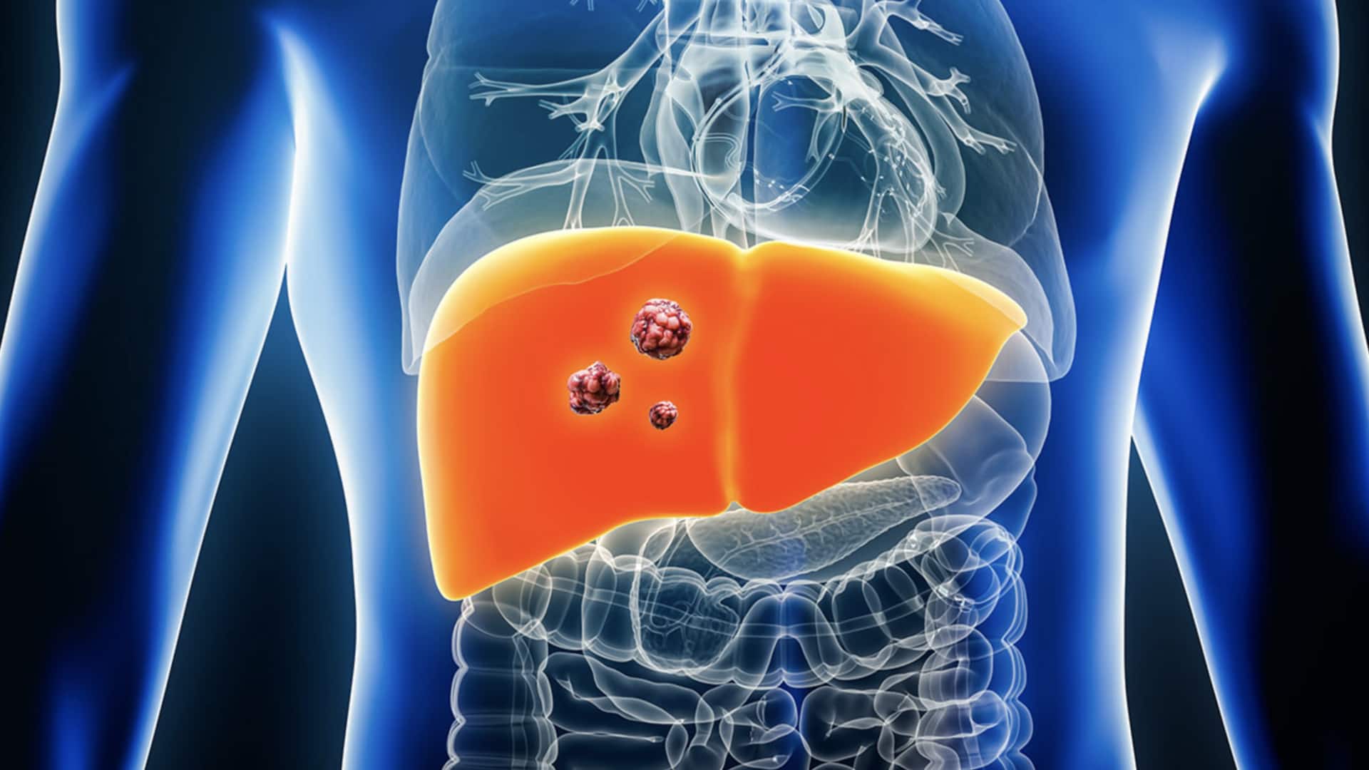 60% liver cancer cases preventable via lifestyle changes and vaccination 60% liver cancer cases preventable via lifestyle changes and vaccination