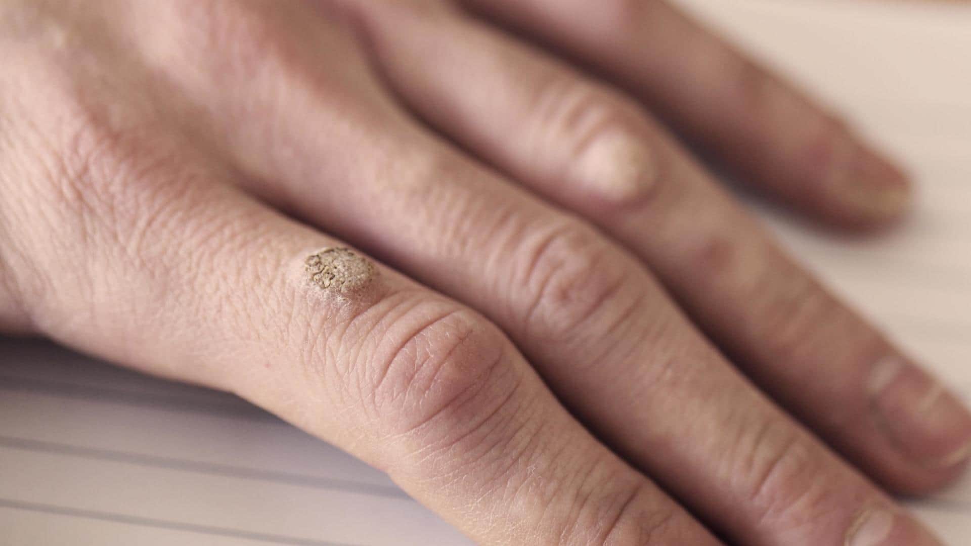 Troubled with warts? Try these home remedies for some relief