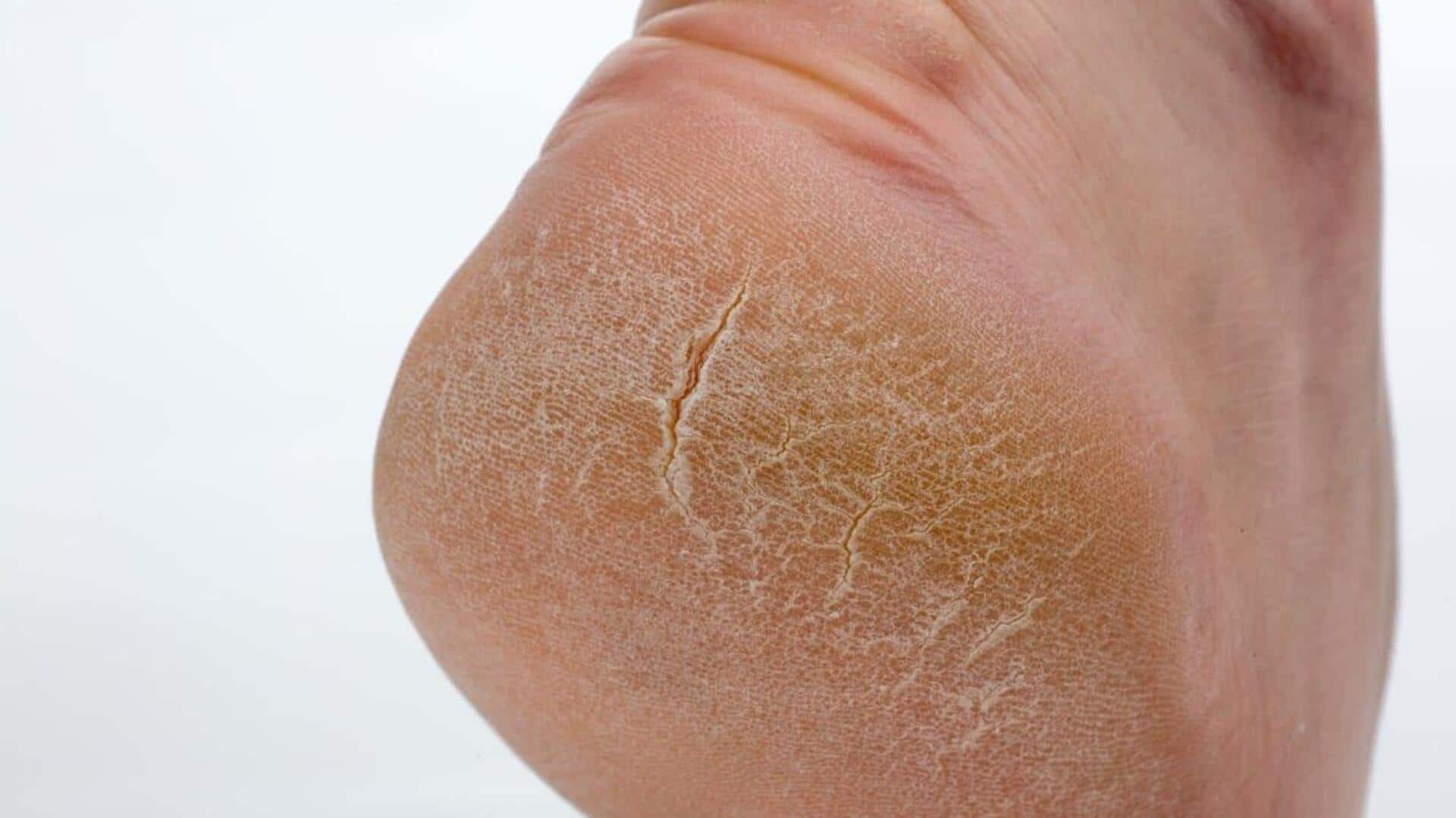 5 ways lavender oil helps fix cracked heels