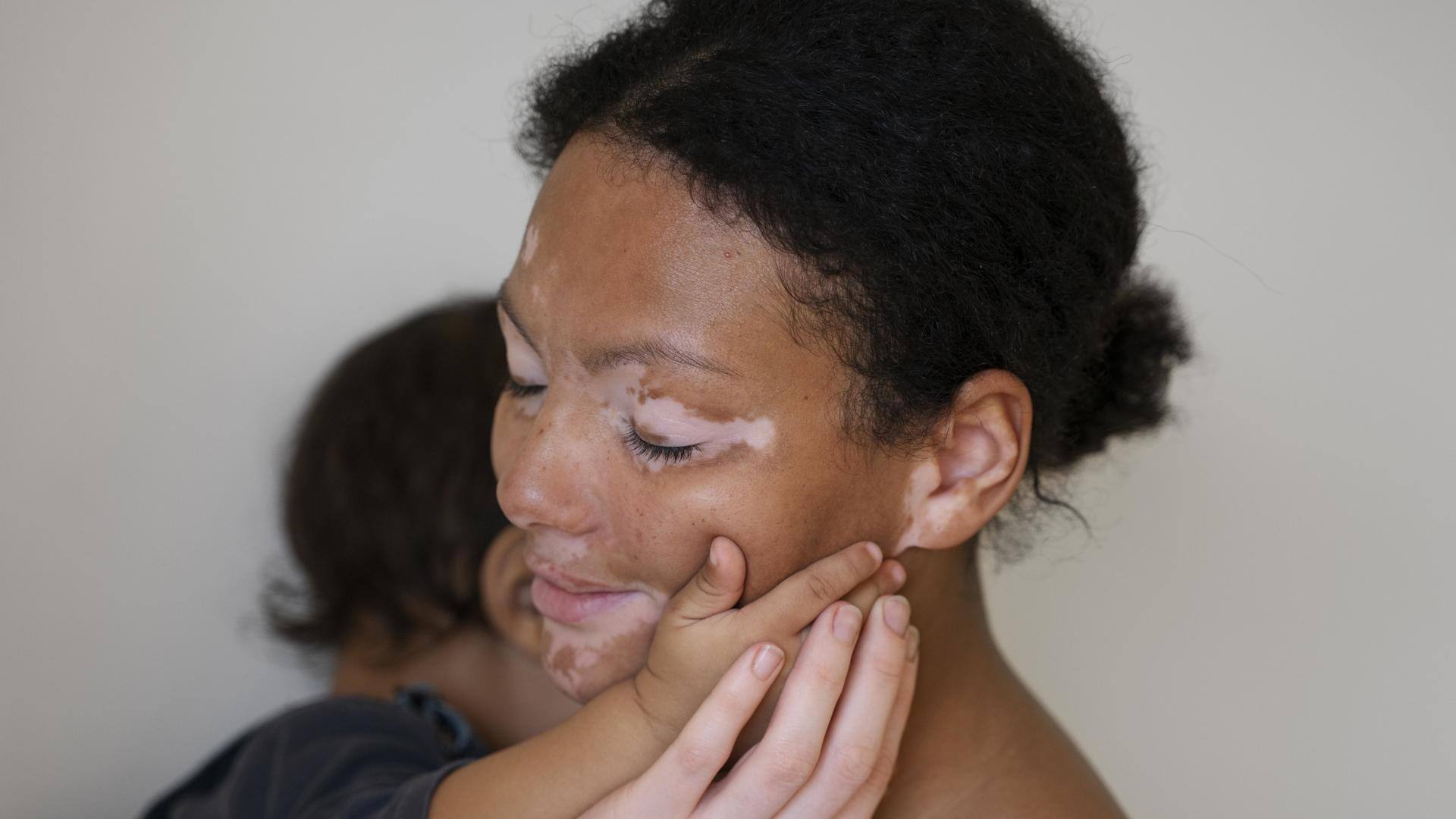 Busting myths about vitiligo