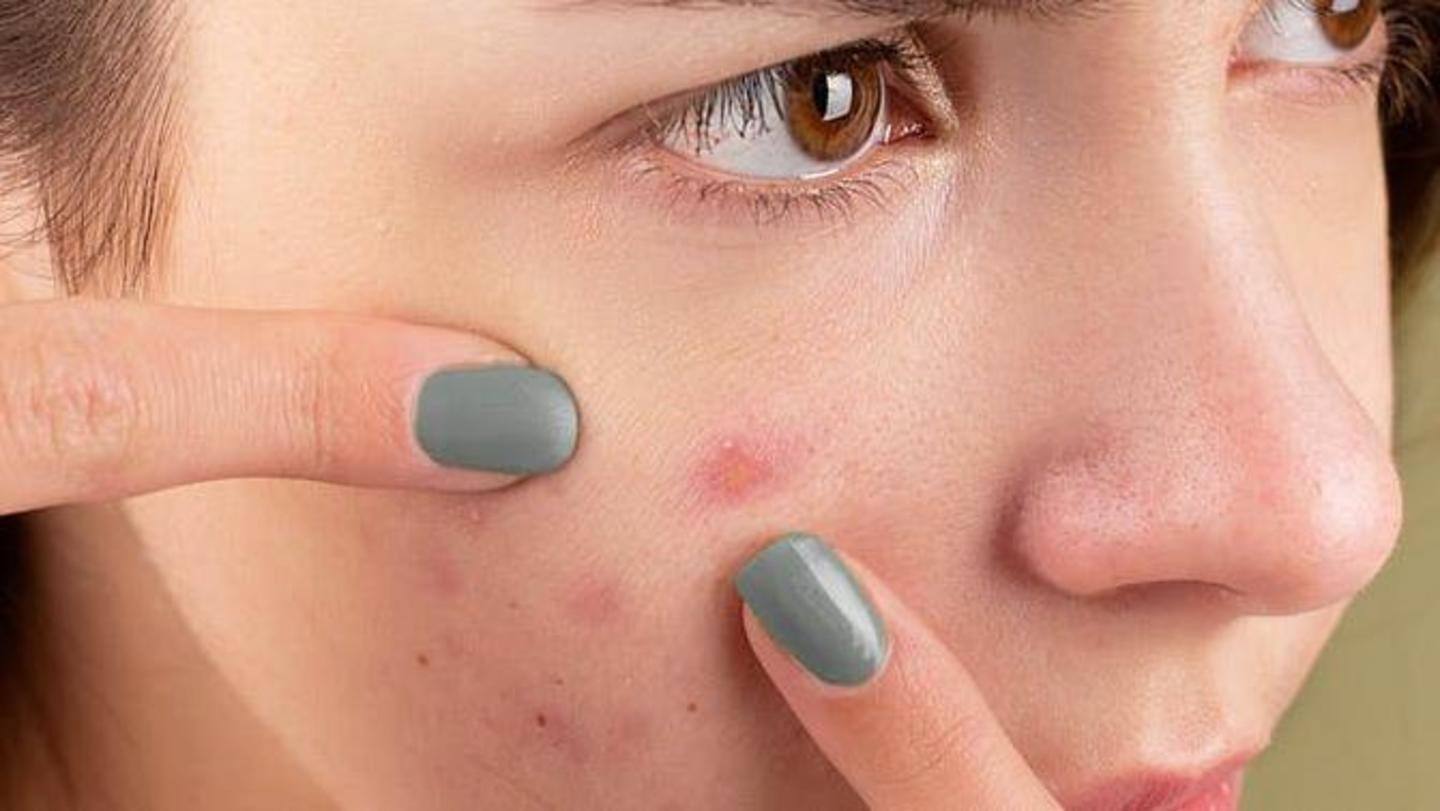 Lightens acne and scars Lightens acne and scars