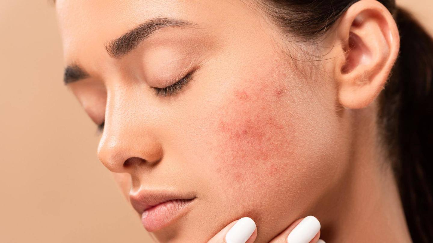 It is an effective remedy to reduce acne marks It is an effective remedy to reduce acne marks