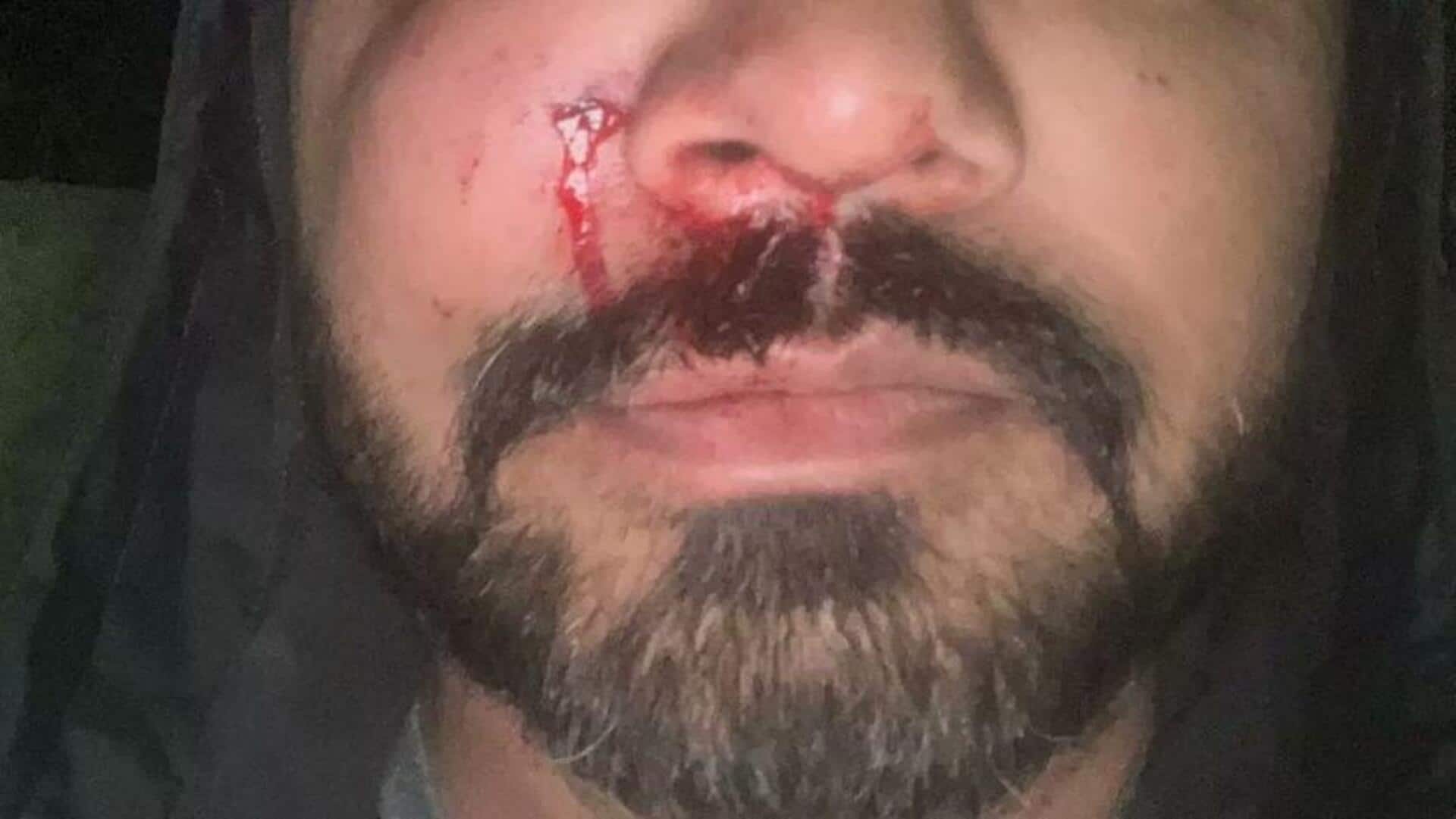 Dublin-based Indian-origin man beaten, cheekbone fractured in unprovoked 'racist' attack Dublin-based Indian-origin man beaten, cheekbone fractured in unprovoked 'racist' attack