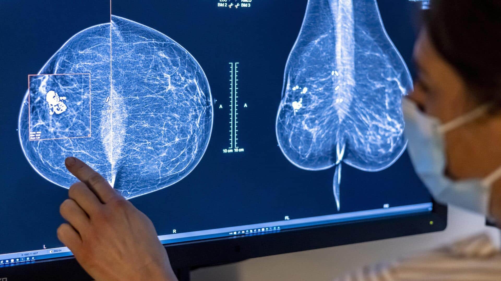 AI-backed mammography detects more cancers, cuts later diagnoses by 12%