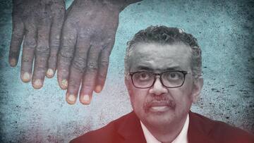 Monkeypox scare: WHO advises bisexual men to limit sexual partners