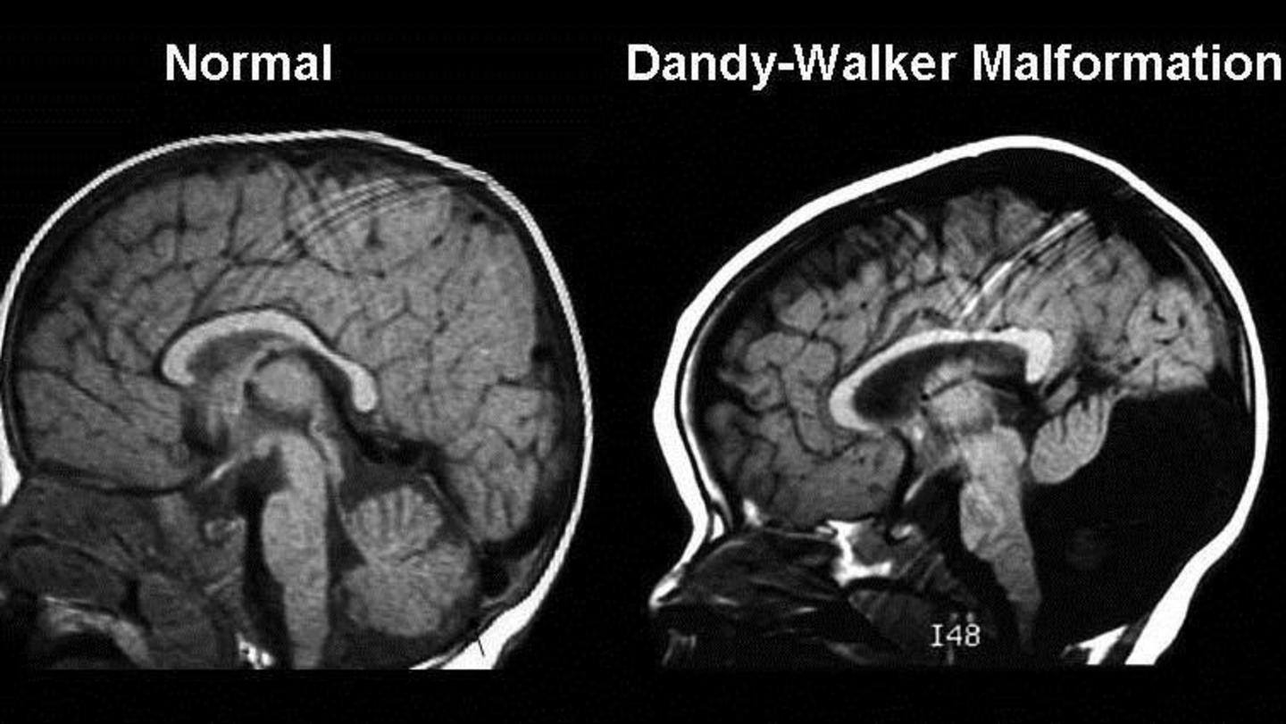 The twin fetus suffered from 'Dandy-Walker Malformation' The twin fetus suffered from 'Dandy-Walker Malformation'