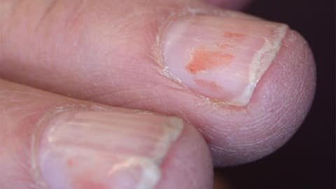 Fix split fingernail at home: Here's how