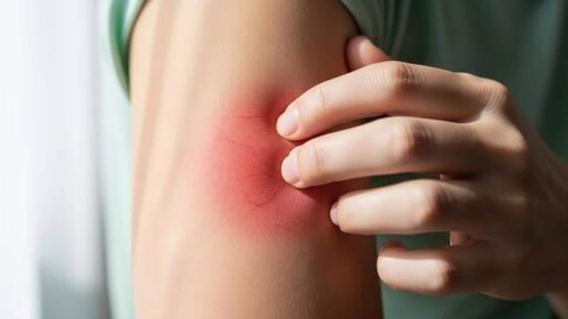 Debunking all myths about blisters 