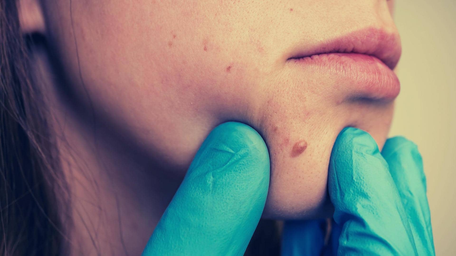From meaning to causes, here's everything about skin tags