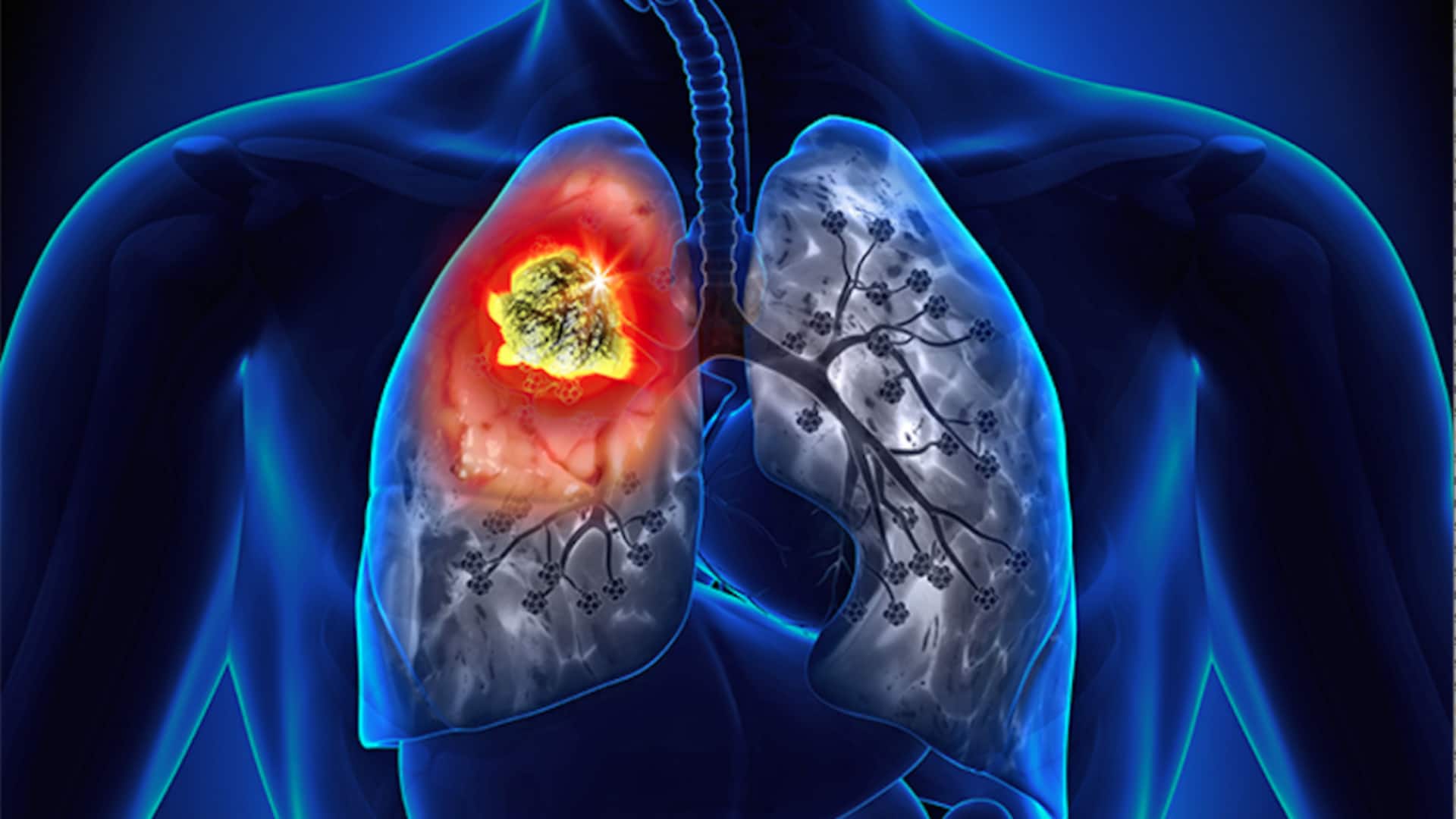 Air pollution linked to lung cancer in non-smokers