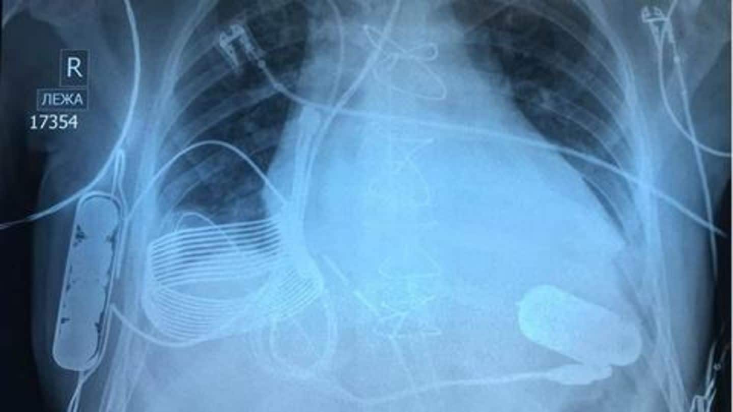 Kazakh doctors recently implanted a bionic heart that charges wirelessly