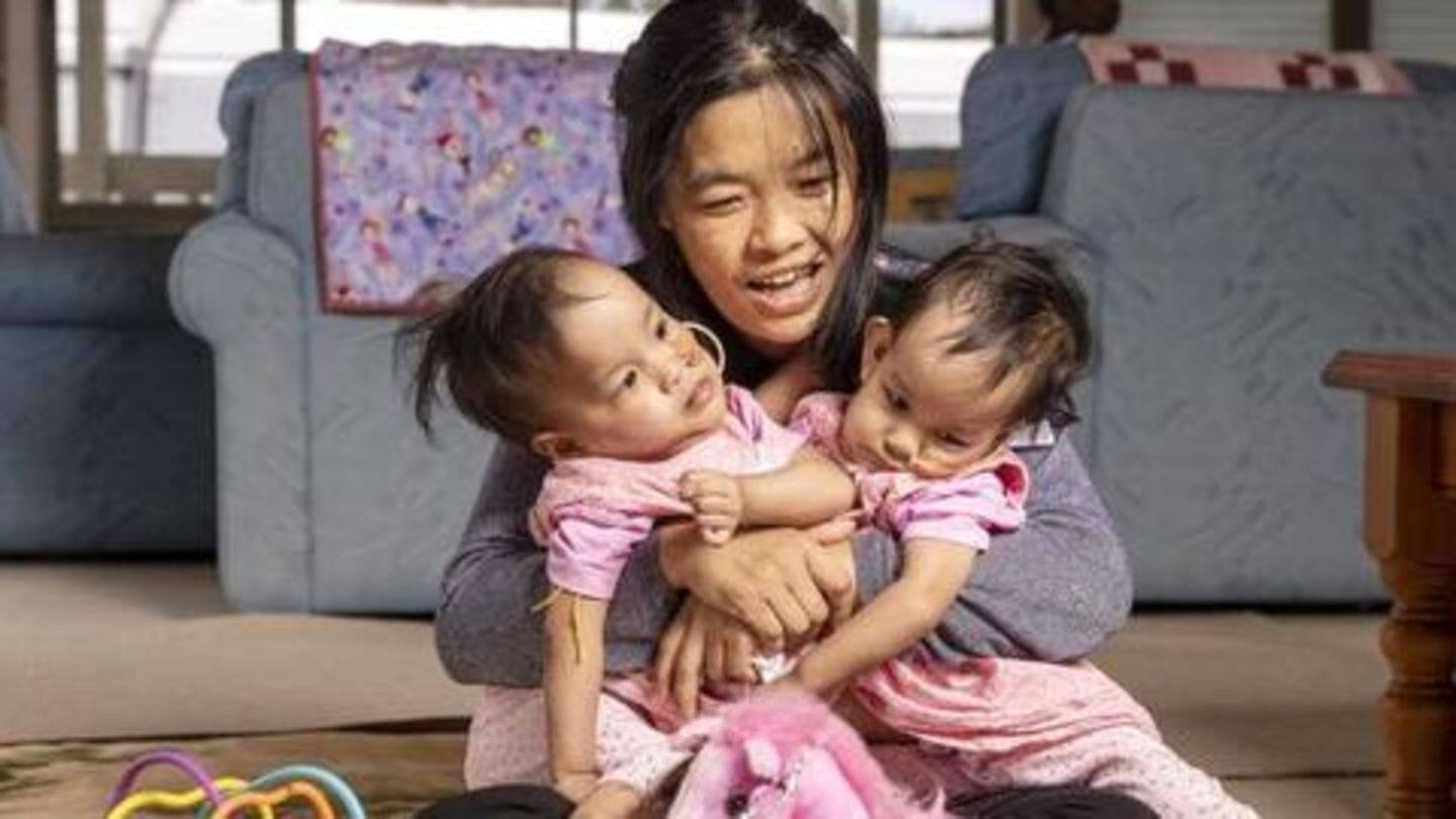 Melbourne: Conjoined Bhutanese twins with shared liver successfully separated