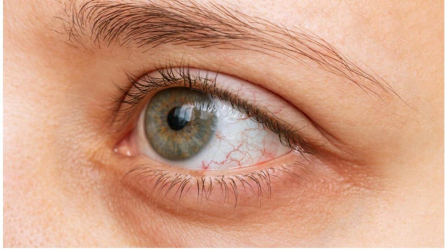 Penyebab utama mata kering