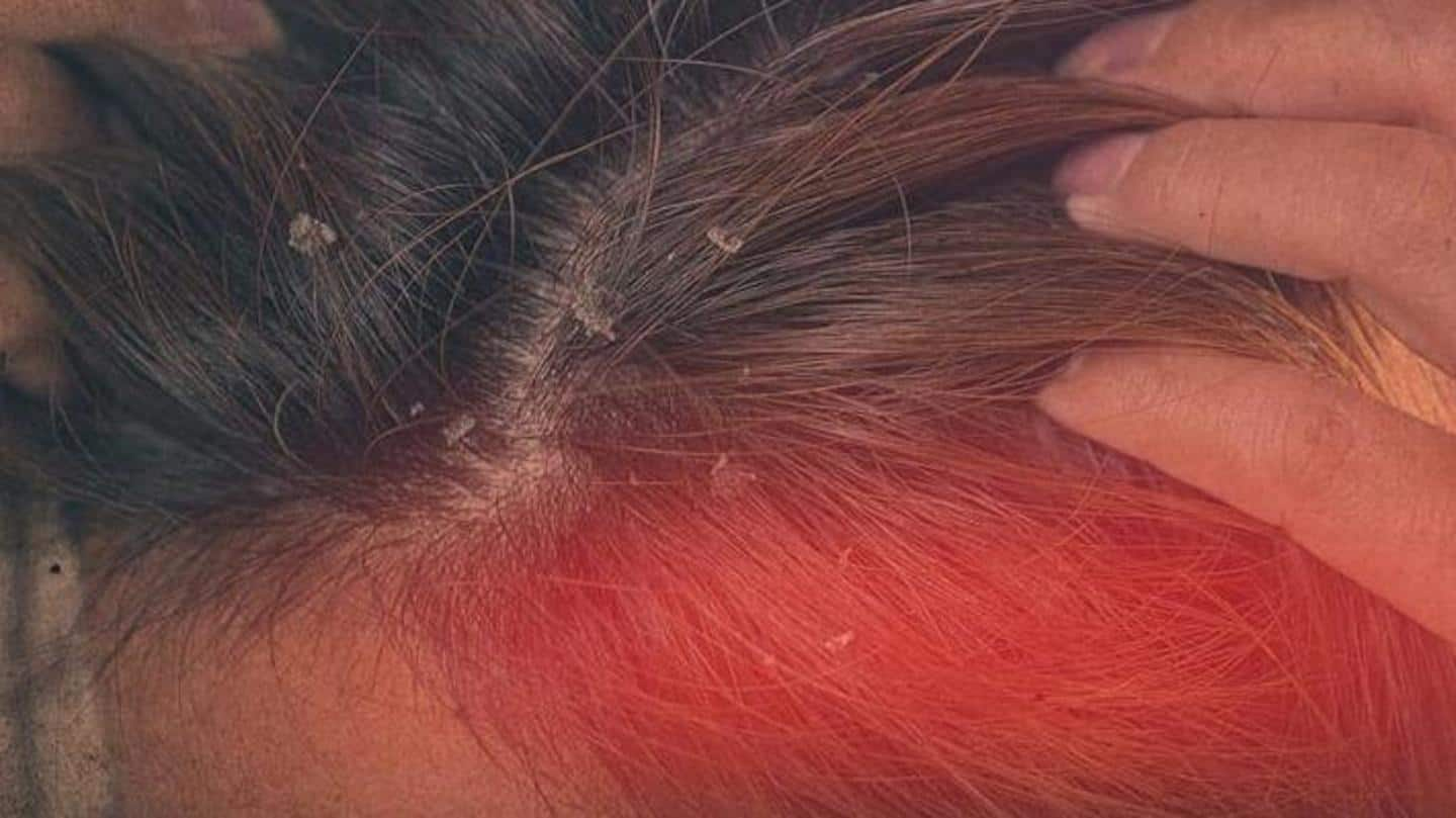 Apa itu dermatitis seboroik? Kenali gejala, penyebab, dan pengobatannya