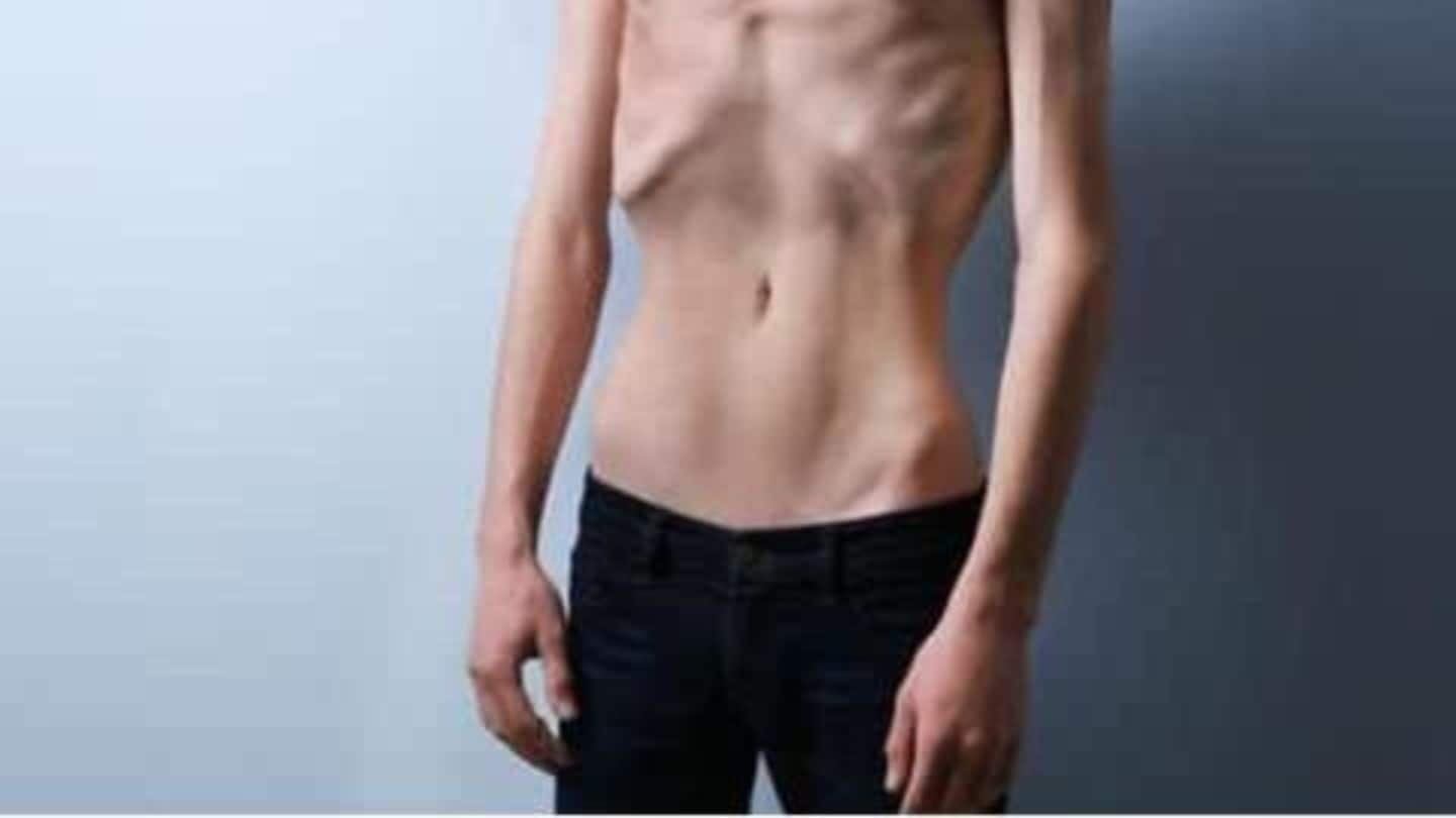 Anorexia nervosa Anorexia nervosa