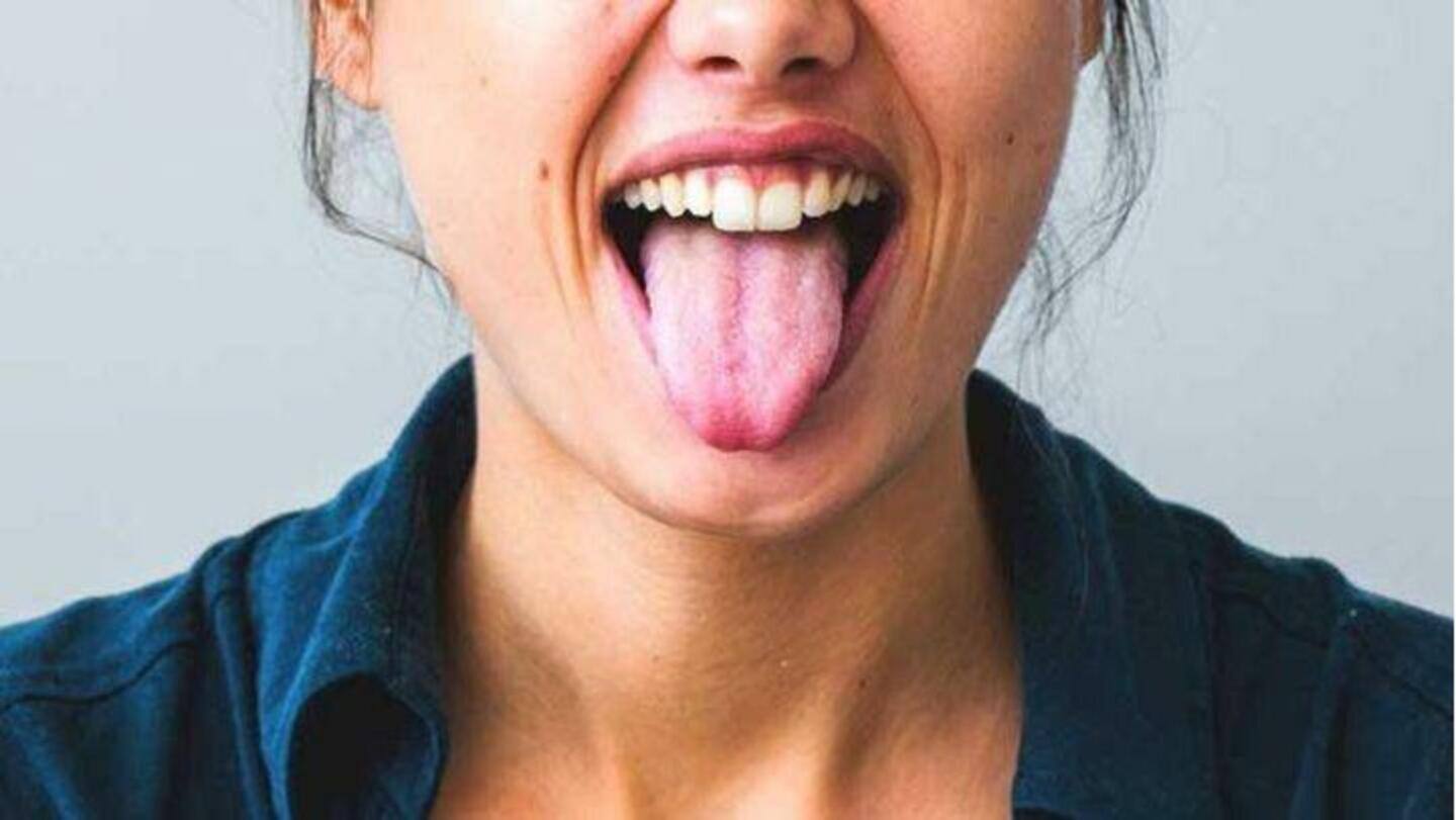 Mengalami lidah putih? Kenali penyebabnya, obatnya, dan pencegahannya