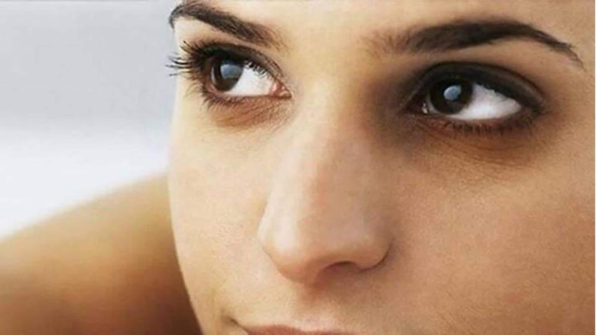 #HealthBytes: Cara mengatasi lingkar hitam di bawah mata