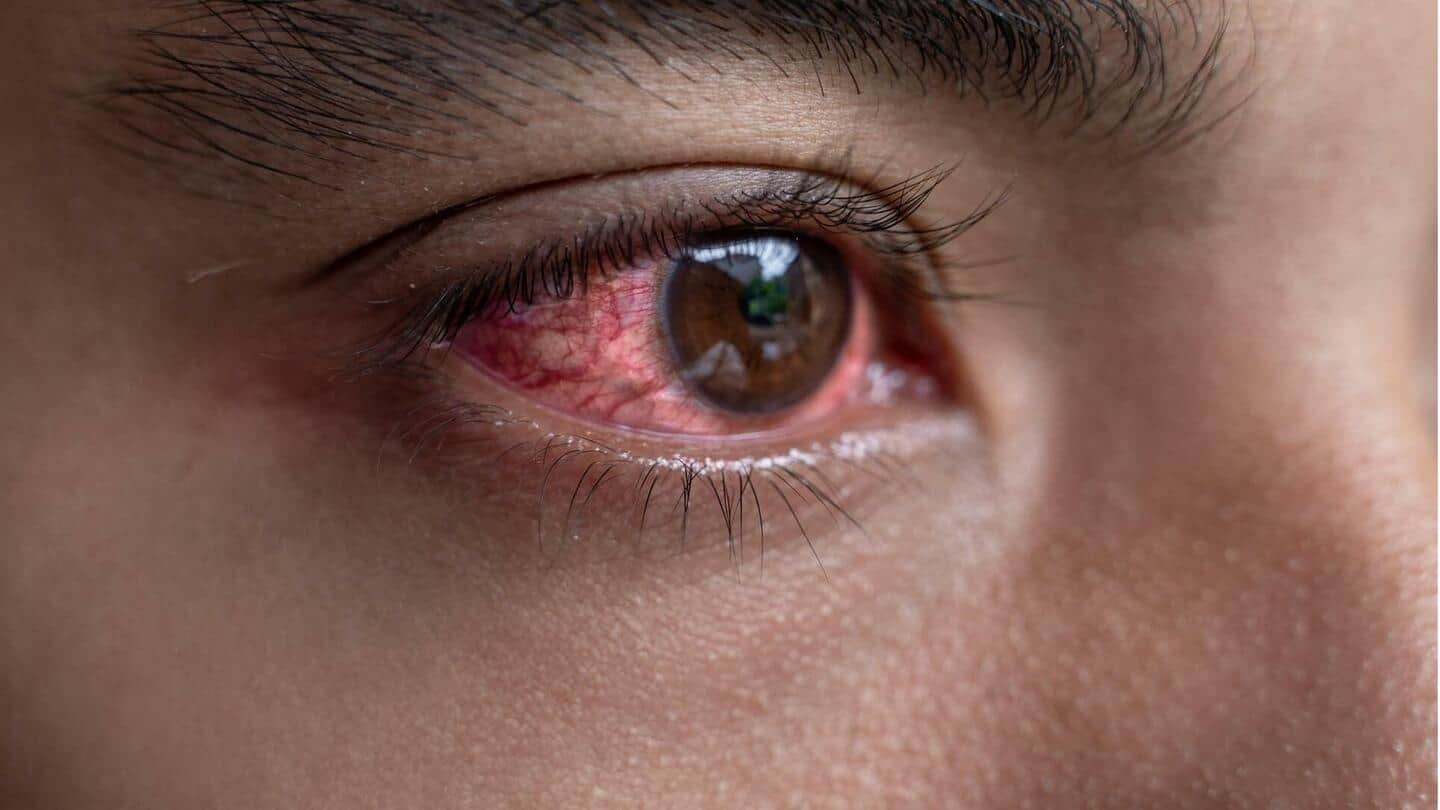 Konjungtivitis: Makanan yang membantu penyembuhan infeksi mata ini