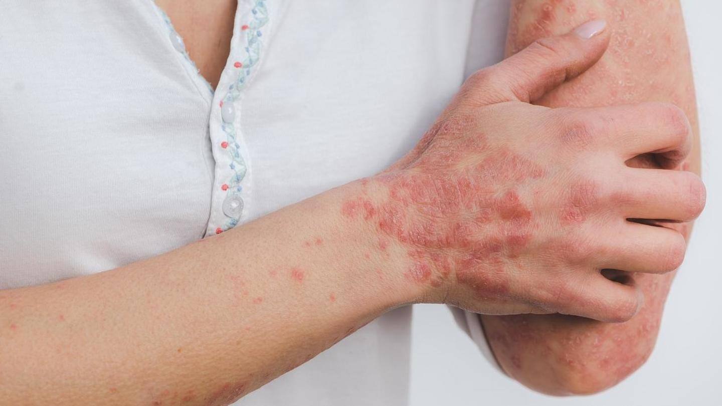 Psoriasis: Dari gejala hingga pengobatan, inilah yang perlu Anda ketahui