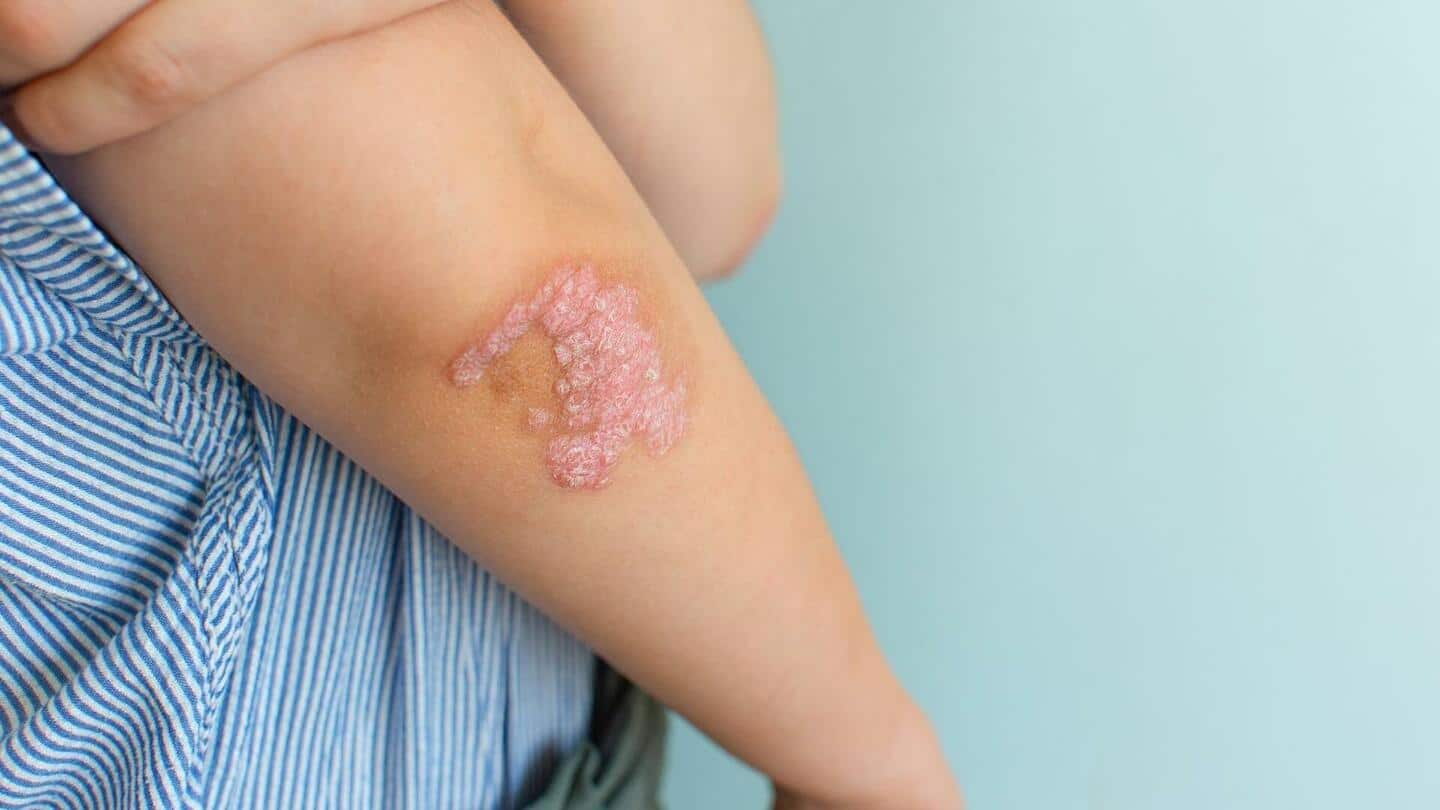 Psoriasis: Kelola gejala dengan pengobatan rumahan ini