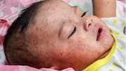 பங்களாதேஷில் தட்டம்மை பரவல்: பலி எண்ணிக்கை 300ஐ தாண்டியது