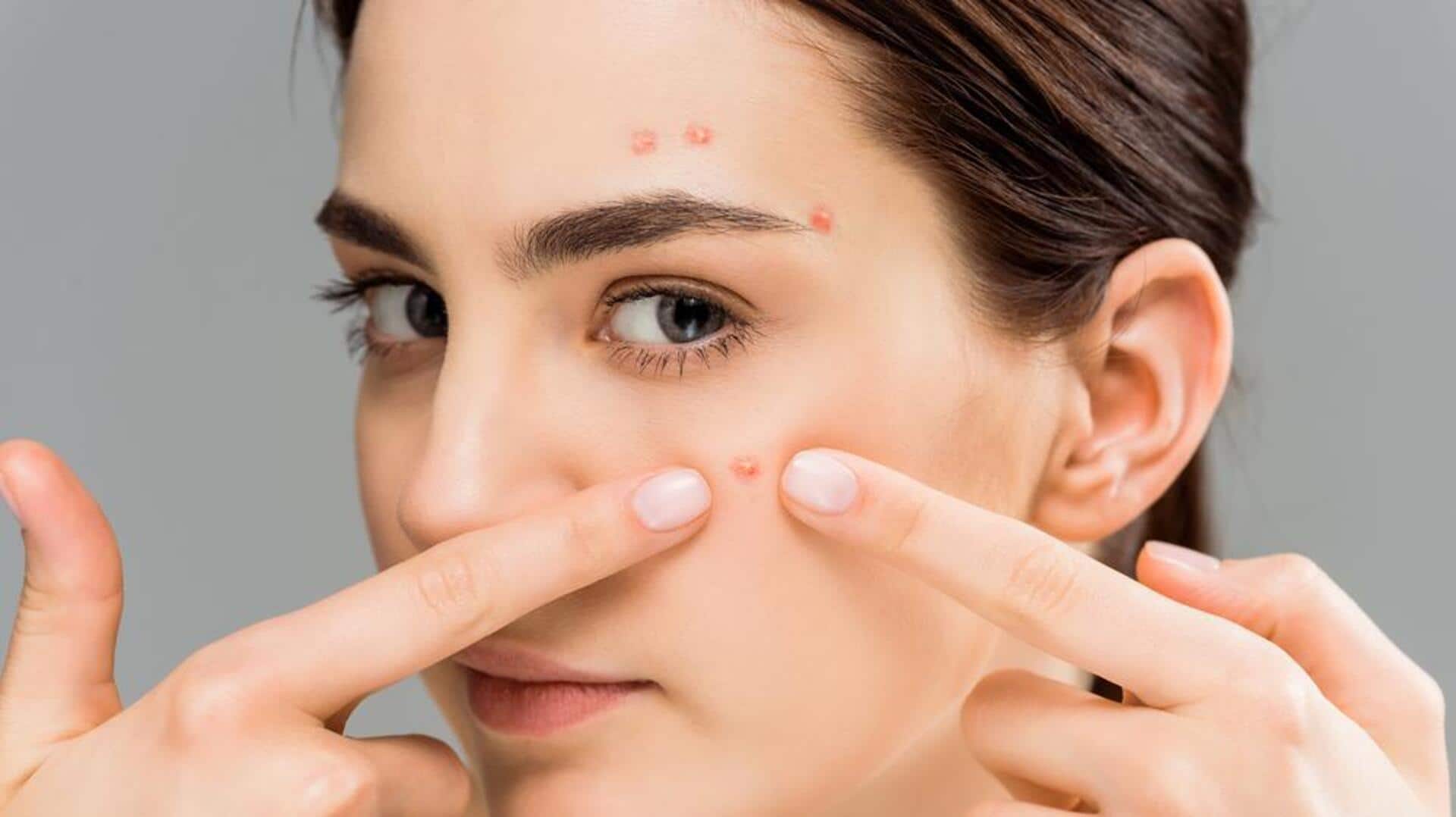 முகப்பரு தொல்லையா? இந்த 5 தவறுகளைச் செய்யாதீர்கள்!