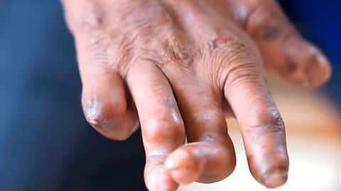 உலக தொழுநோய் தினம்: தொழுநோய் தொற்றக்கூடியதா? நீங்கள் தெரிந்து கொள்ள வேண்டிய உண்மைத் தகவல்கள்