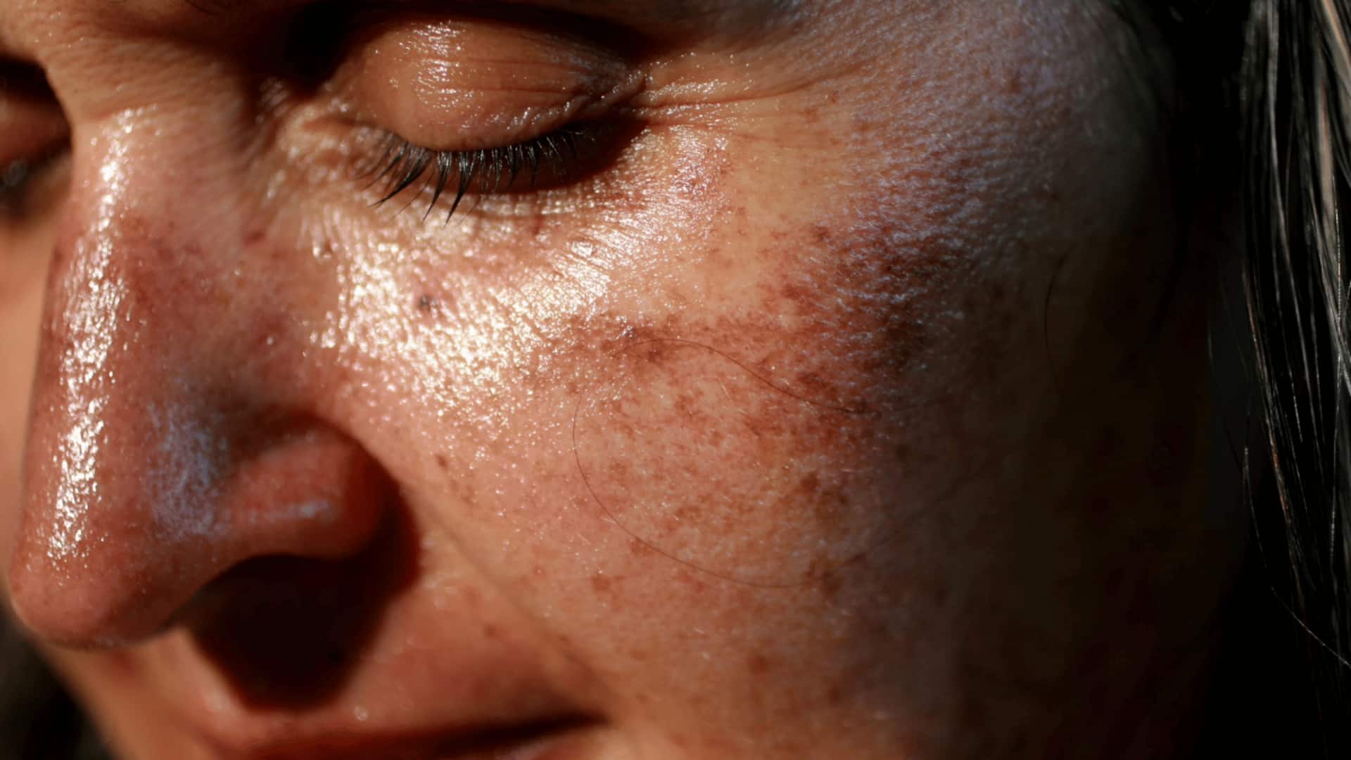 Skin Tips: ఎండ దెబ్బకు చర్మం కమిలిపోయిందా? ఇలా చేస్తే వెంటనే ఉపశమనం!