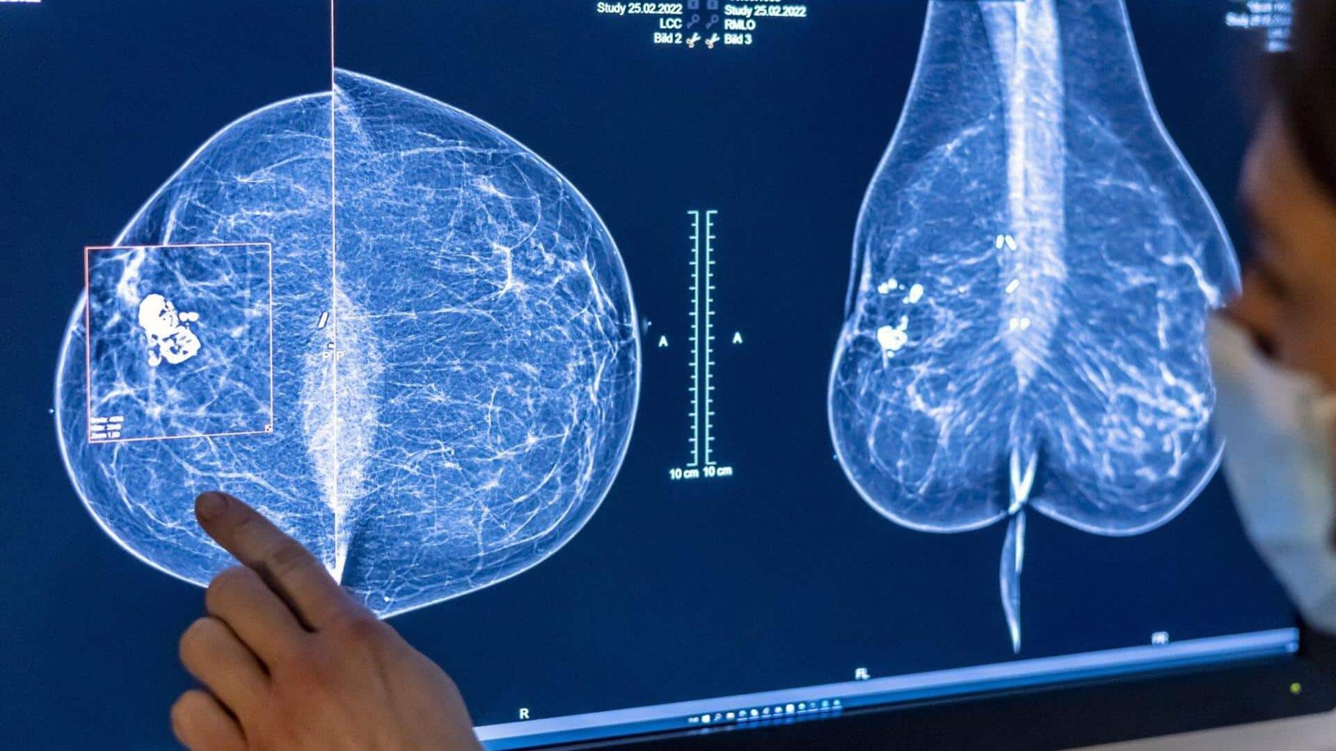 Breast cancer: AI సాయంతో రొమ్ము క్యాన్సర్ స్క్రీనింగ్‌లో విప్లవం: క్యాన్సర్ రేటు 12% తగ్గింది