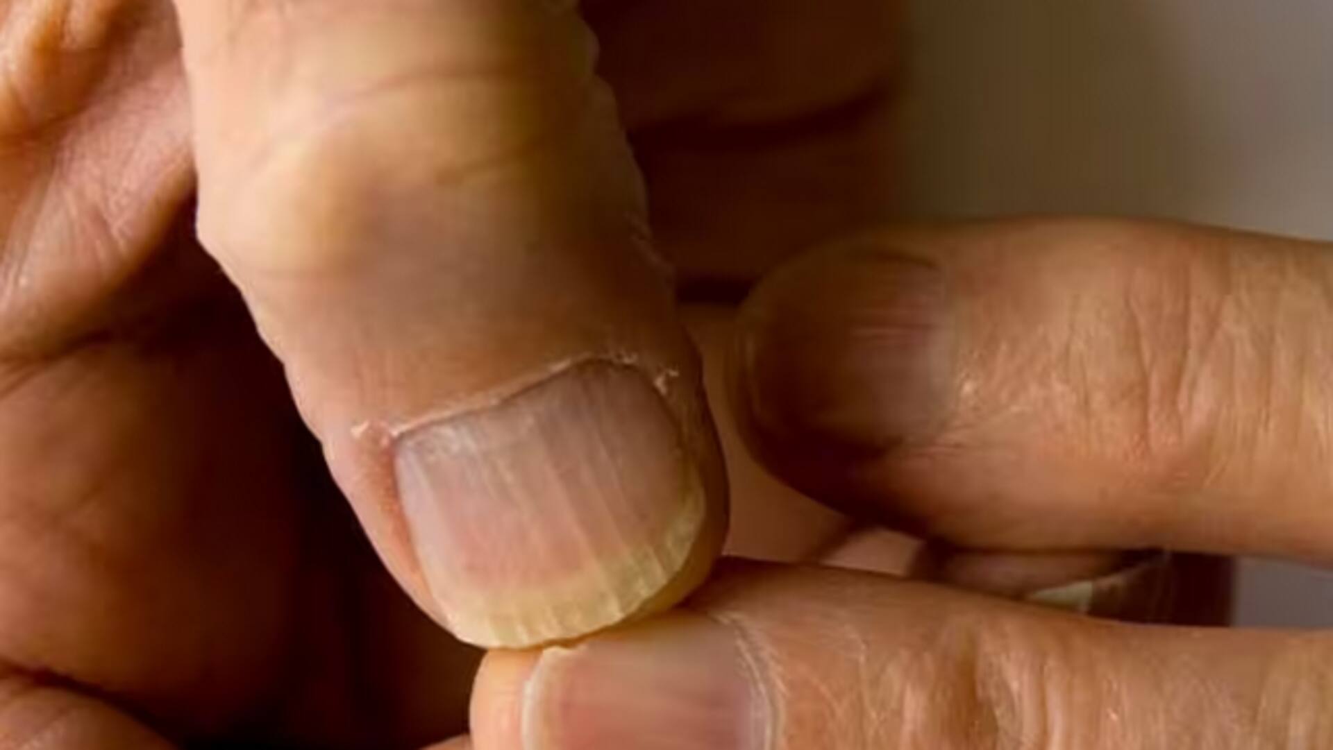 B12 For Nails : చేతి గోళ్లు ఆరోగ్యంగా ఉన్నాయా..లేకపోతే ఇవి పాటించండి