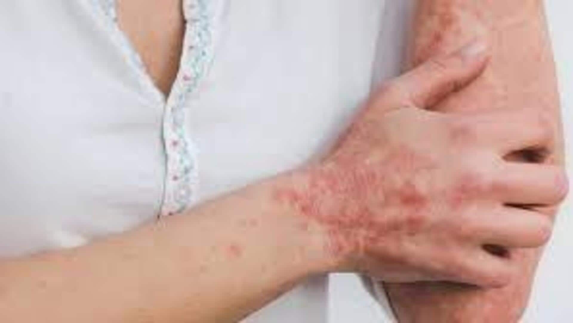 World Psoriasis Day : నేడు ప్రపంచ సోరియాసిస్ దినోత్సవం.. అవగాహనతోనే ఉపశమనం! World Psoriasis Day : నేడు ప్రపంచ సోరియాసిస్ దినోత్సవం.. అవగాహనతోనే ఉపశమనం!