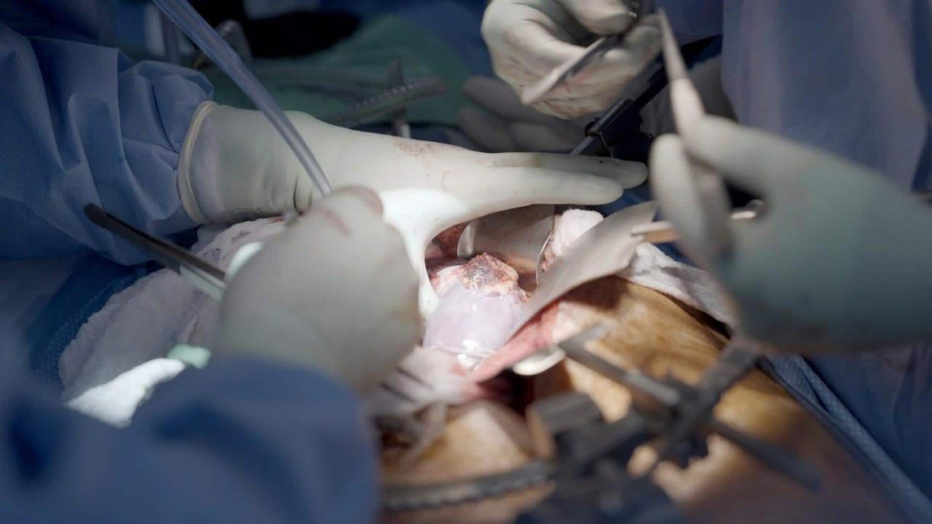 Transplant: ప్రపంచంలోనే తొలిసారి.. ఒకే వ్యక్తికి పంది కాలేయం, రెండు కిడ్నీలు అమర్చిన చైనా వైద్యులు