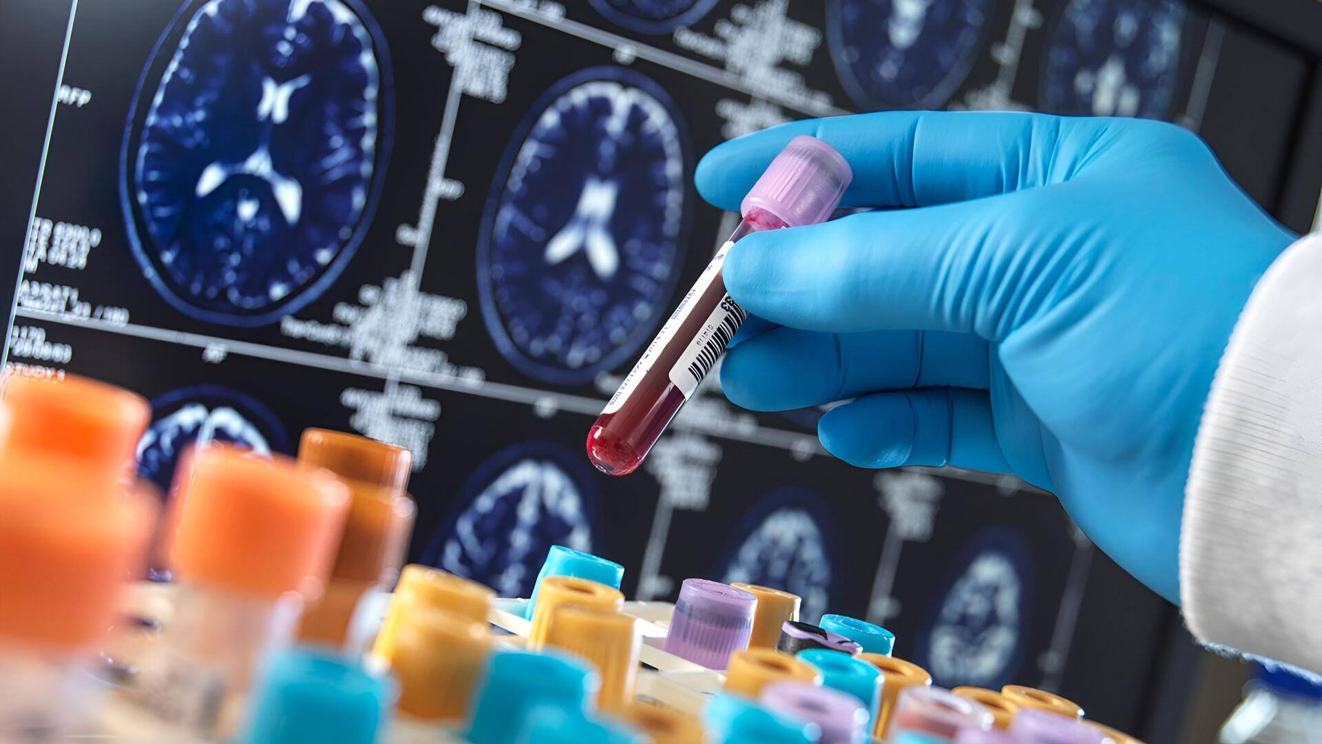 Blood Test: ఒకే రక్త పరీక్షతో పలురకాల డిమెన్షియా వ్యాధుల గుర్తింపు.. కొత్త అధ్యయనంలో కీలక విషయాలు!