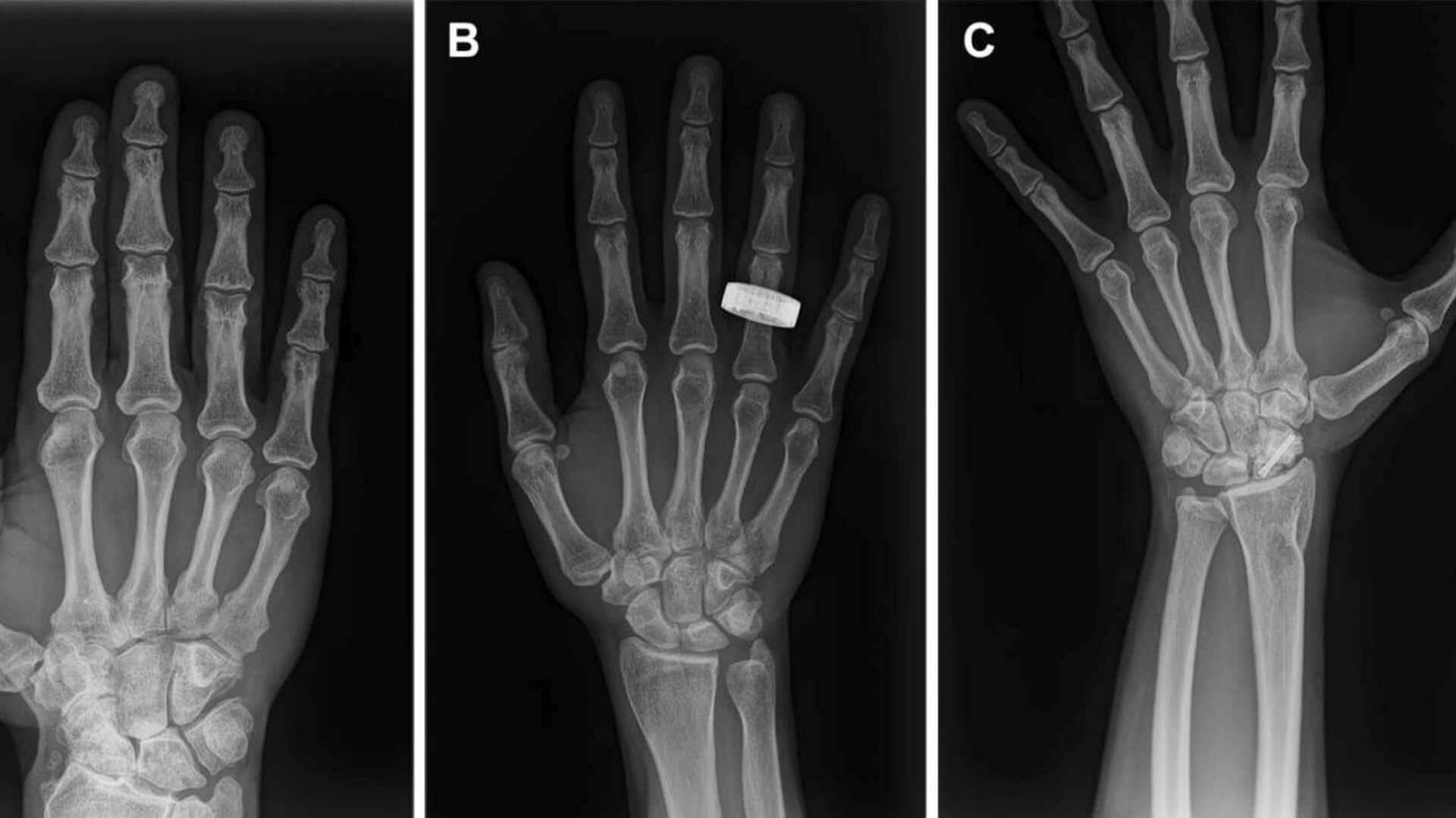 Human X-Rays: అంతరిక్షంలో తొలిసారిగా మనుషుల ఎక్స్‌రేలు.. వ్యోమగాముల ఆరోగ్య సంరక్షణలో కీలక ముందడుగు
