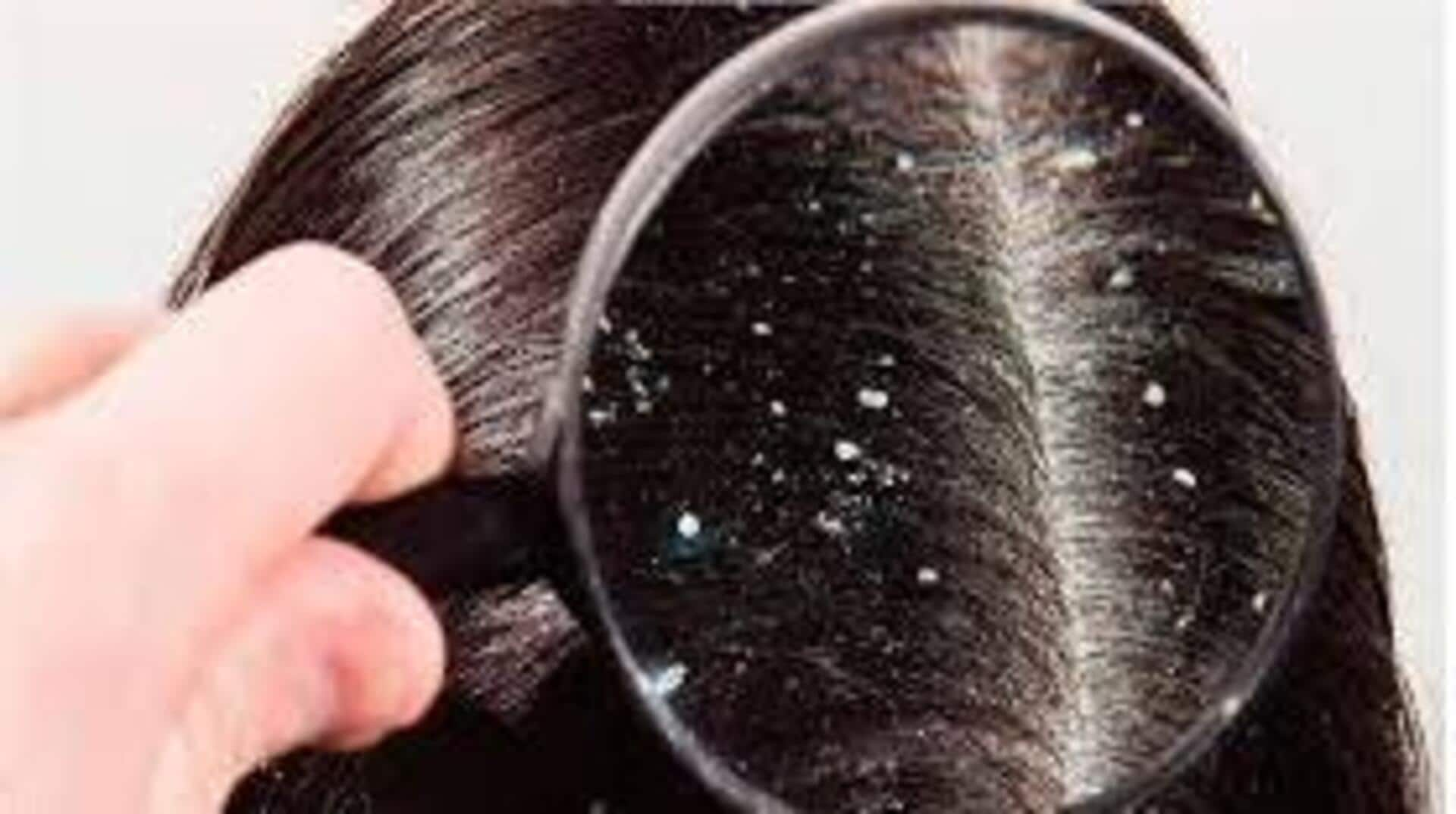 Dandruff: చలికాలంలో చుండ్రు సమస్య.. సొల్యూషన్ ఇదిగో!