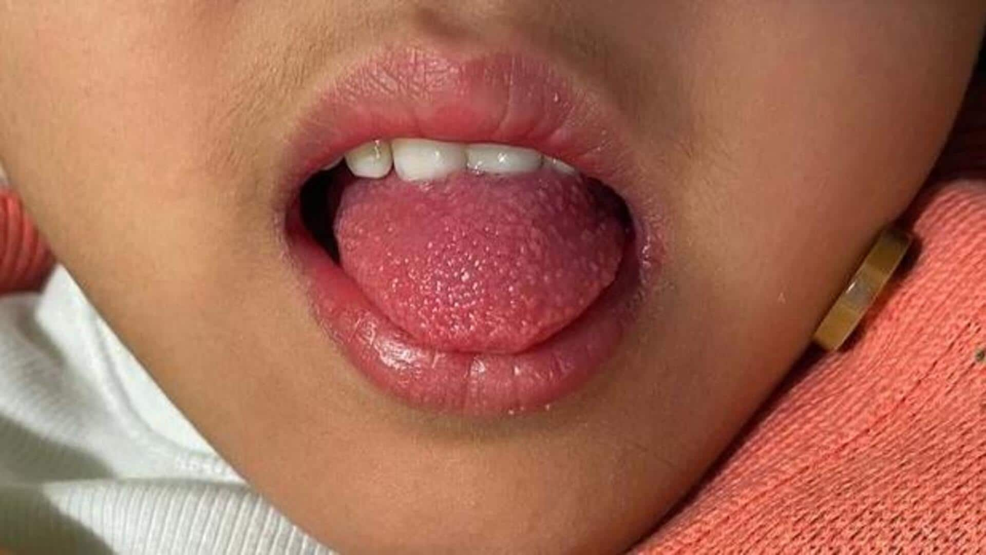 Scarlet fever: పిల్లలు జాగ్రత్త.. హైద‌రాబాద్‌లో వేగంగా విస్తరిస్తున్న స్కార్లెట్ ఫీవ‌ర్ కేసులు