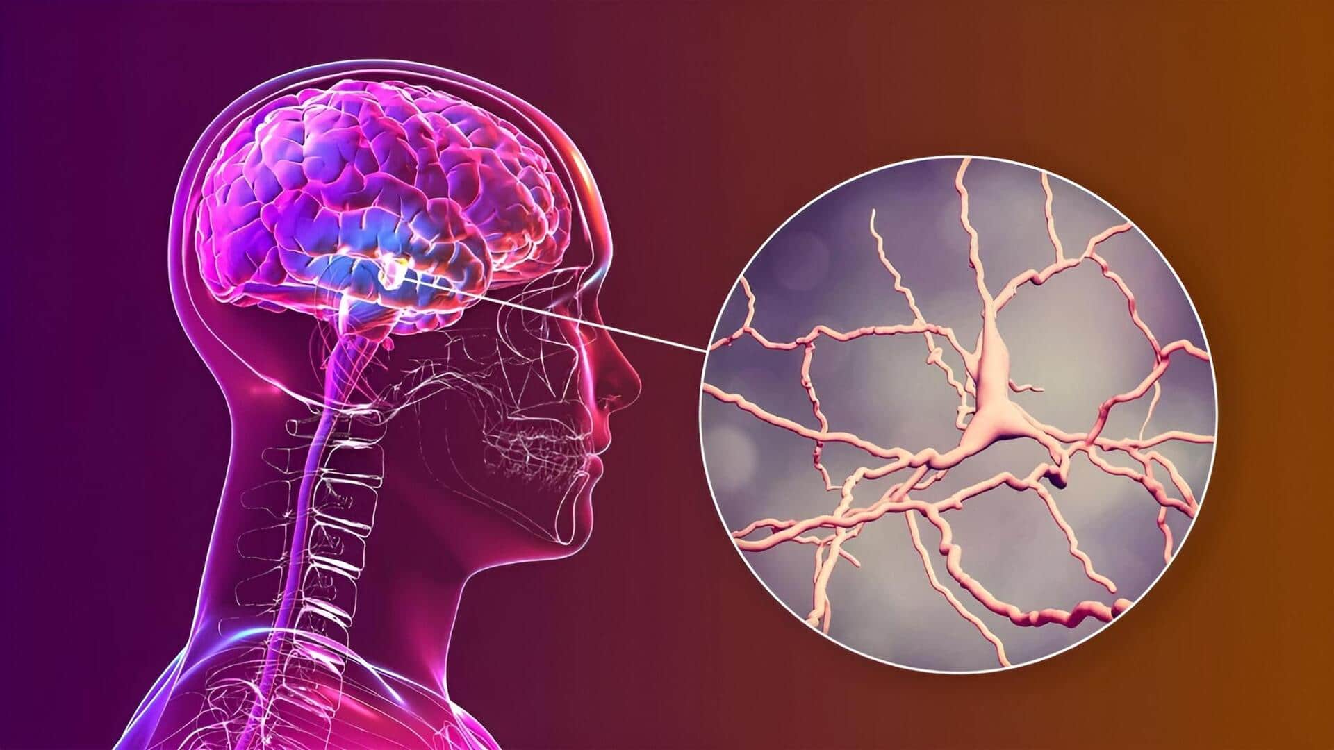 Parkinson's Disease: మెదడులోని రక్తనాళాల్లో మార్పులే పార్కిన్సన్స్ వ్యాధి తీవ్రతకు కారణం.. ఆస్ట్రేలియా పరిశోధనలో కీలక విషయాల వెల్లడి