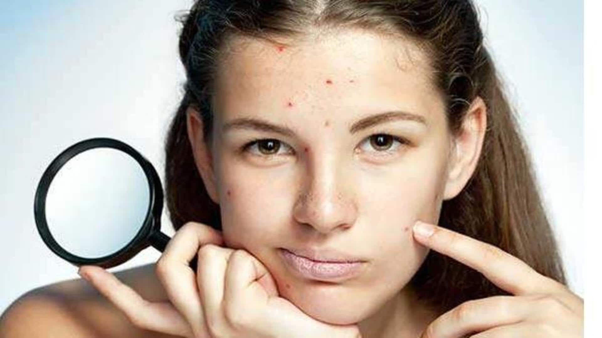 Pimples: మొటిమలు వచ్చినప్పుడు చర్మ సంరక్షణ కోసం ఈ 5 పద్ధతులను ప్రయత్నించండిలా..