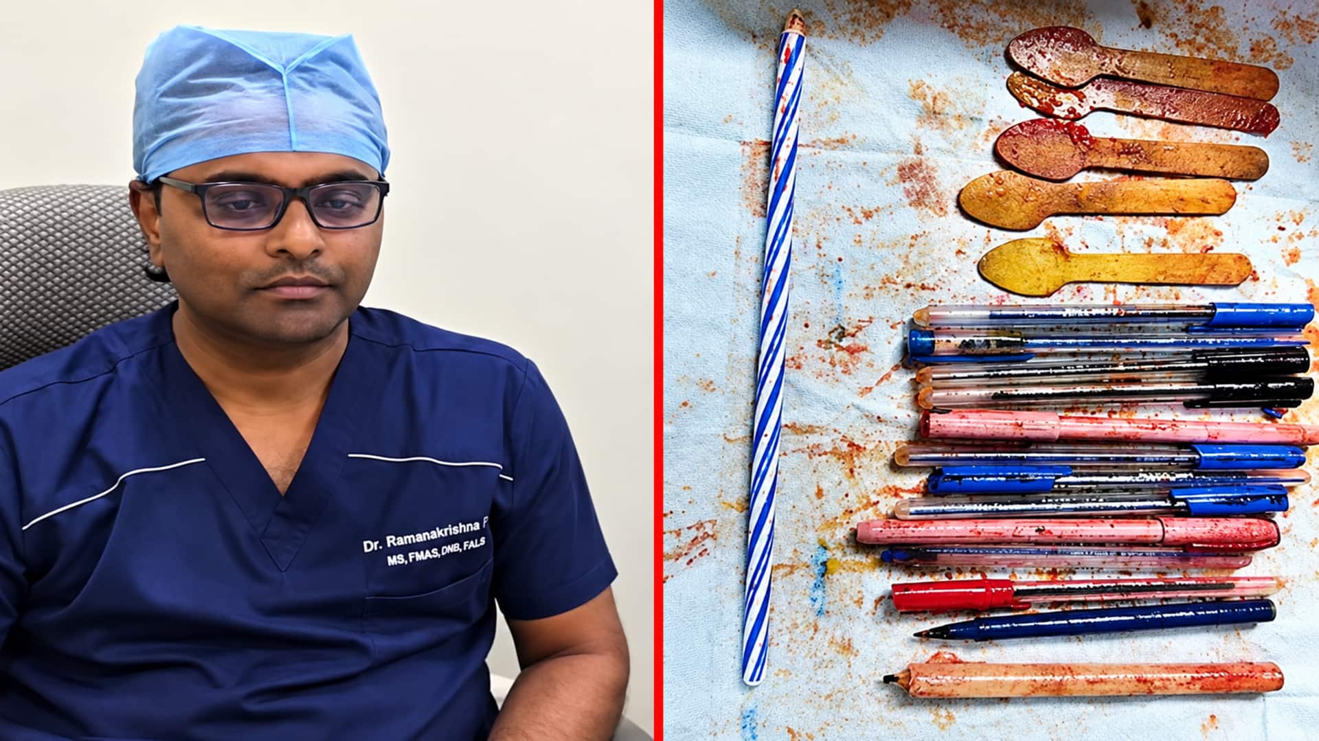 Viral Video: పల్నాడులో షాకింగ్ ఘటన.. మహిళ కడుపులో 14 పెన్నులు, 5 స్పూన్లు,కొవ్వొత్తి.. వైద్యుల షాక్!