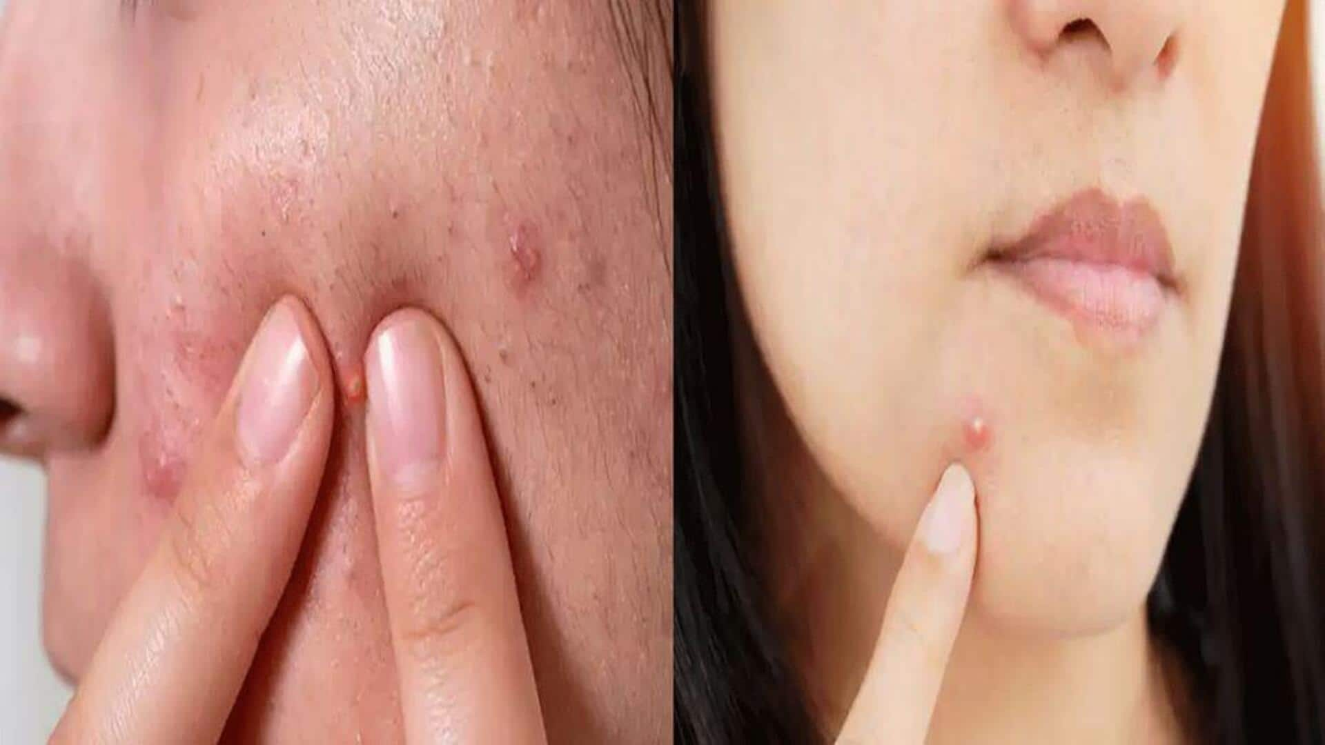 Pimples: వాలెంటైన్స్ డే ముందు ముఖంపై ఉన్న మొటిమలను ఎలా తగ్గించుకోవాలి?