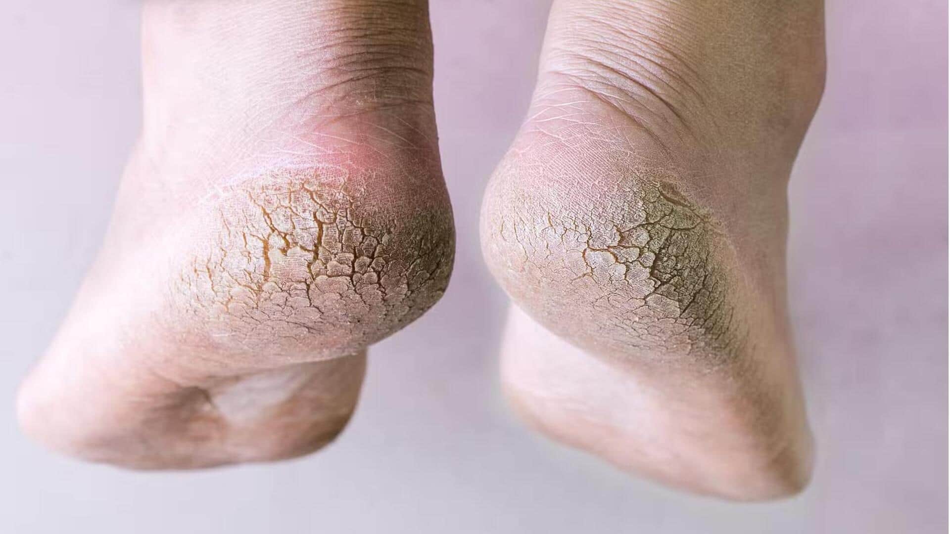 Cracked Heels: పగిలిన పాదాలకు గుడ్‌బై చెప్పండి… ఈ 6 ఇంటి చిట్కాలతో కాళ్లు స్మూత్‌గా మారుతాయి