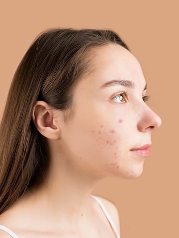 All about postpartum acne