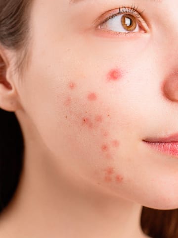 5 habits that make acne worse