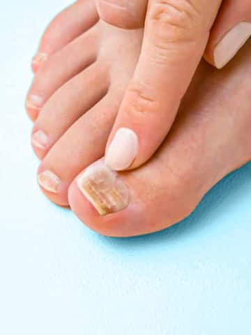 5 home remedies for toenail fungus