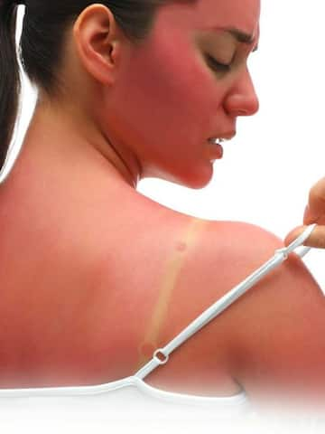 5 homemade remedies for sunburn