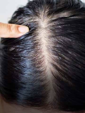 5 homemade remedies for dry scalp