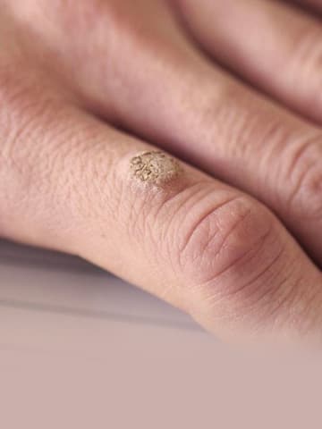 5 home remedies for warts