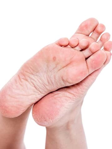 5 home remedies for calluses