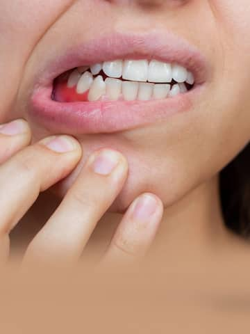 5 home remedies for bleeding gums