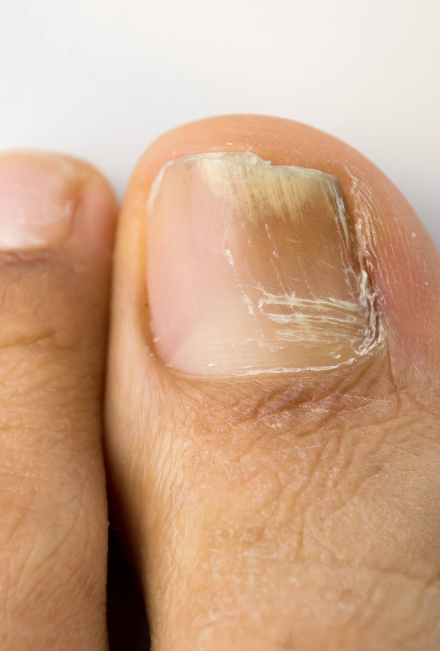 Toenail Fungus Remedies, Reported Cures, Treatments, and Natural  Applications - HubPages